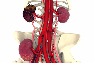 Dialysis Treatment in Latur Best Doctor For Dialysis Treatment in Latur